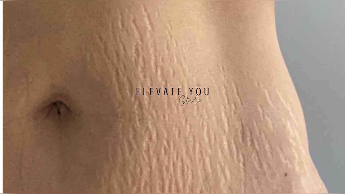 Close view of stretch marks on skin being treated with fine needling